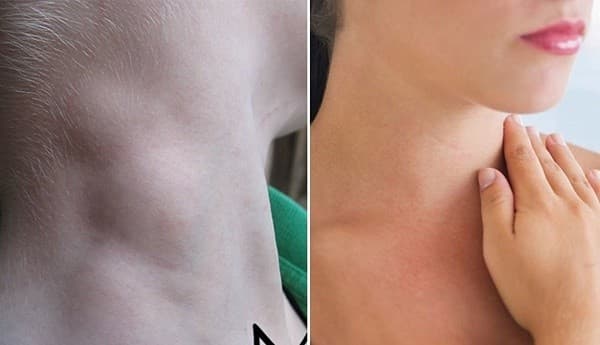 Ung thư hạch bạch huyết là bệnh gì