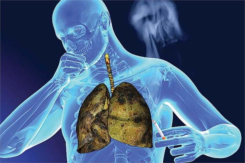 Bệnh nhân ung thư phổi giai đoạn cuối phải chịu nhiều đau đớn, cơ thể gầy sút