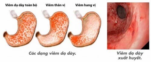 Các dạng viêm dạ dày cần được phát hiện sớm và điều trị hiệu quả