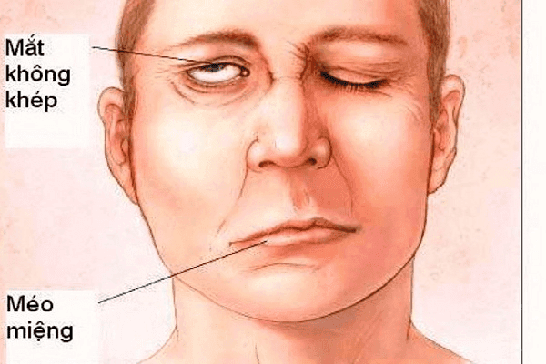 Liệt nửa mặt, liệt vận động, rối loạn ngôn ngữ, rối loạn cơ tròn,.... là những di chứng mà bệnh xuất huyết não có thể gây nên