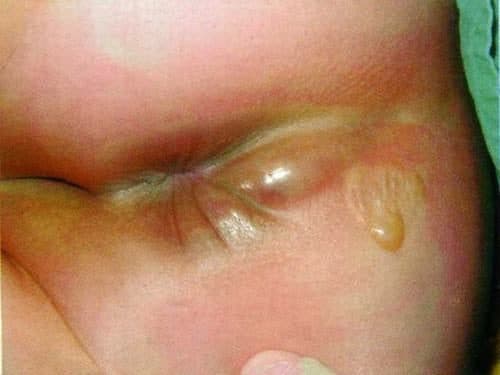 Khi bị rò hậu môn, trẻ thường có biểu hiện nổi một khối sưng đỏ, đau, mưng mủ nằm ở vùng quanh hậu môn