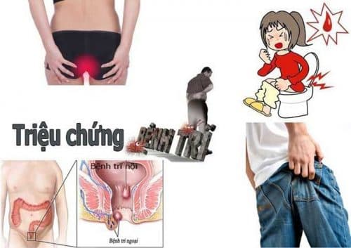 Trĩ là bệnh thường gặp ở đường tiêu hóa gây ảnh hưởng xấu tới sức khỏe và sinh hoạt của người bệnh