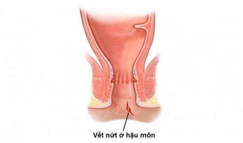 Nứt kẽ hậu môn cũng là một trong những bệnh ở hậu môn nguy hiểm mà người bệnh cần hết sức lưu ý