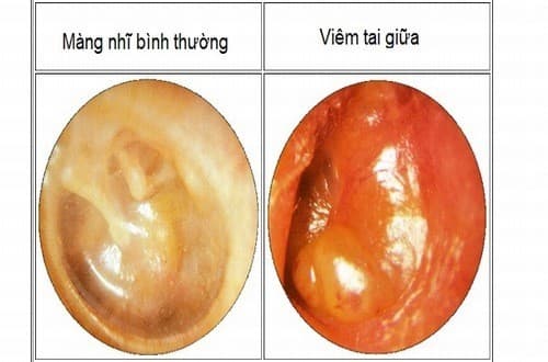 Cẩn trọng với bệnh viêm tai giữa