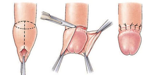 Phẫu thuật cắt bao quy đầu thực hiện thế nào?