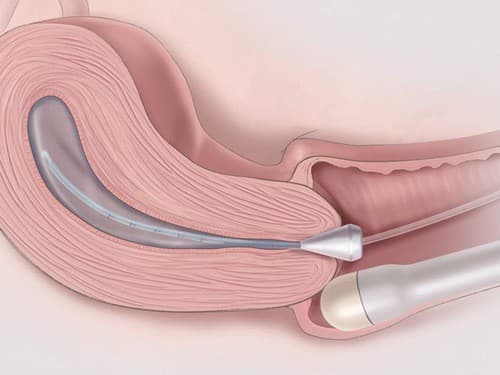 Siêu âm thông qua âm đạo đầu thai kỳ cho kết quả rõ ràng, chính xác hơn. 