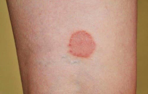 Dấu hiệu của bệnh hắc lào là xuất hiện những mụn nhỏ li ti mọc thành hình tròn xoe như đồng xu.