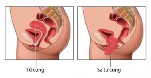 Bình thường tử cung ở ngay bên trên âm đạo, khi xảy ra sa tử cung, tử cung thì sẽ bị tụt xuống lòng âm đạo.