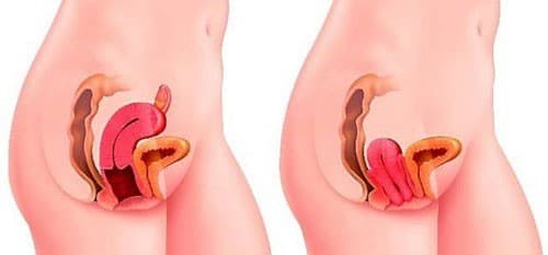 Sa tử cung có thể gây ra một số biến chứng ảnh hưởng sức khỏe và khả năng sinh sản.