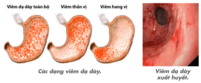 Hình ảnh mô phỏng viêm hang vị dạ dày