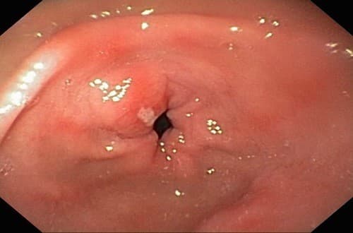 Hình ảnh hang vị dạ dày bình thường