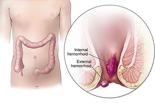Trĩ nội là bệnh thường gặp, ảnh hưởng xấu tới sức khỏe nên cần điều trị sớm