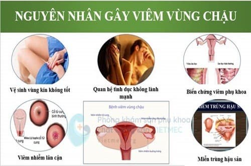 Nguyên nhân viêm vùng chậu ở nữ giới ảnh hưởng đến sức khỏe sinh sản