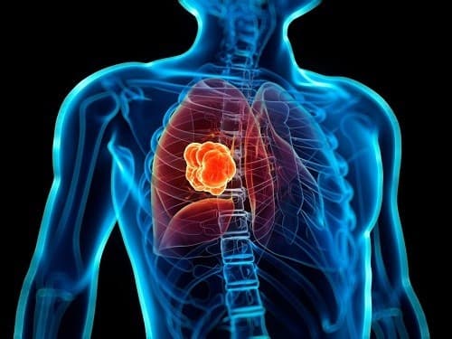 Phòng ngừa ung thư phổi thế nào