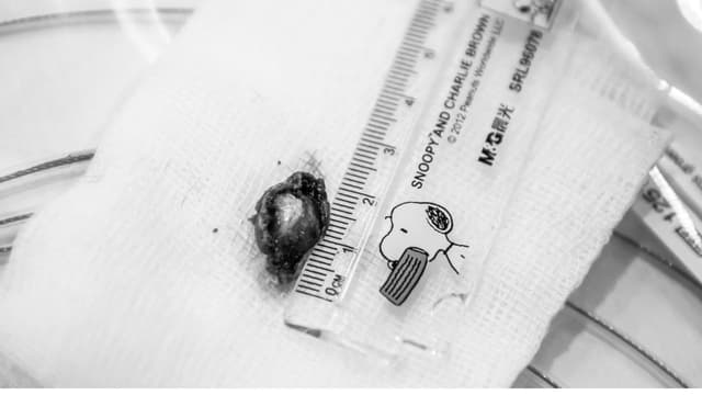 Polyp dạ dày và nguy cơ biến chứng thành ung thư 