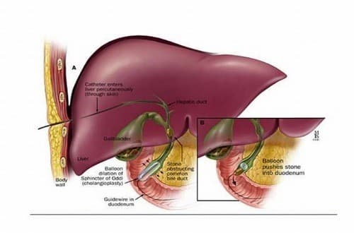 triệu chứng bệnh sỏi gan là gì?