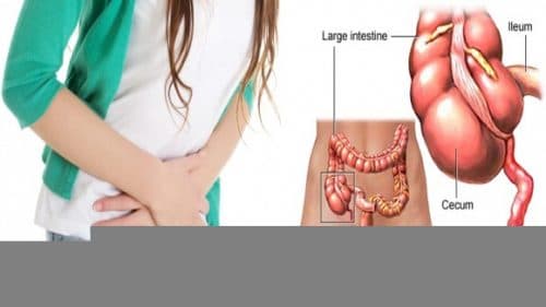 Người bệnh có thể bị viêm phúc mạc hoặc áp xe ruột thừa