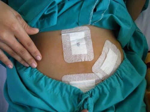 Người bệnh cần phẫu thuật cắt bỏ viêm ruột thừa sớm để ngăn ngừa biến chứng 