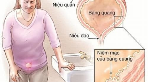 Viêm đường tiết niệu cũng là nguyên nhân gây đau bụng dưới thường gặp