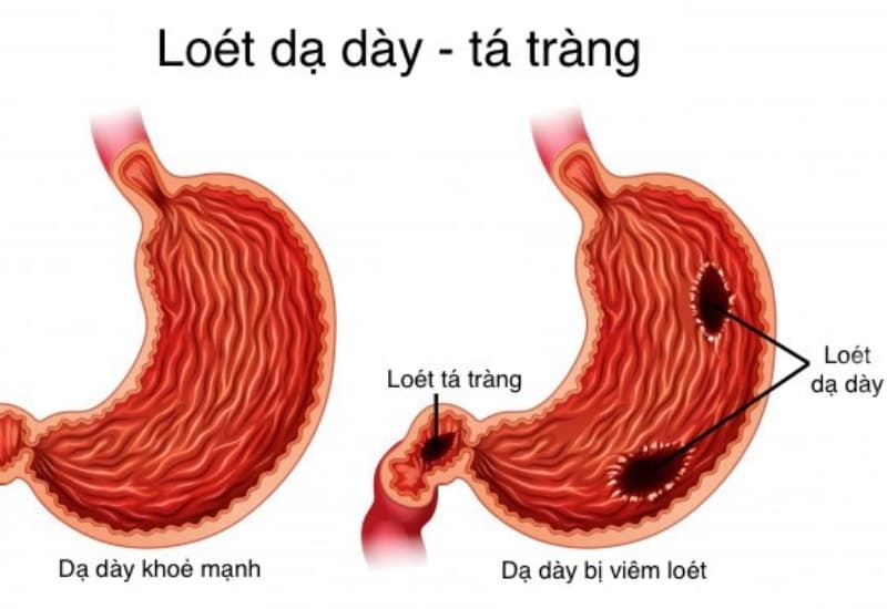 Viêm loét dạ dày phổ biến trong các bệnh về dạ dày
