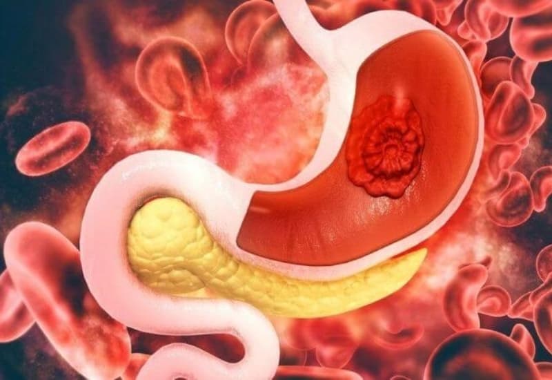 Ung thư dạ dày bắt đầu từ sự phát triển đột biến tế bào trong dạ dày