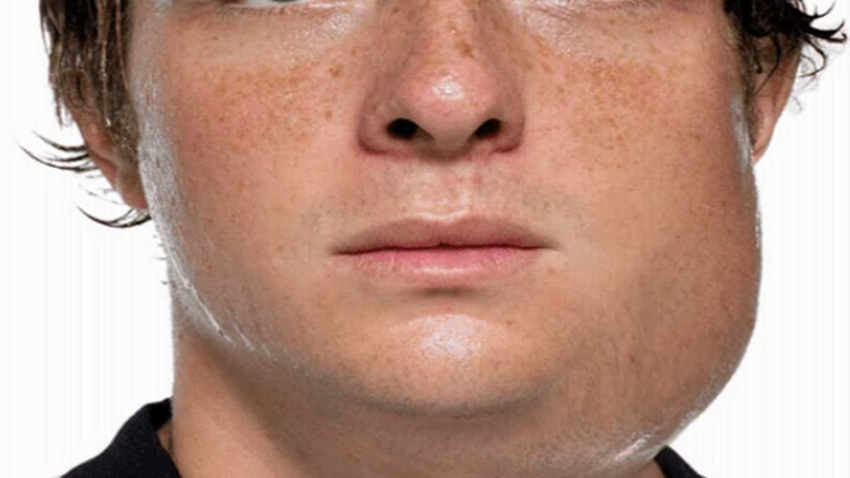 Coi chừng bệnh quai bị ở nam giới