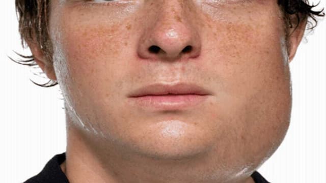 Coi chừng bệnh quai bị ở nam giới