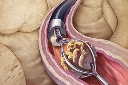 Sỏi thận cần được điều trị hiệu quả