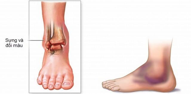 Bong gân chân phải làm sao?chữa trị hiệu quả tránh gây tổn thương