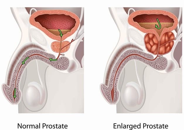 Bệnh tuyến tiền liệt hay gặp