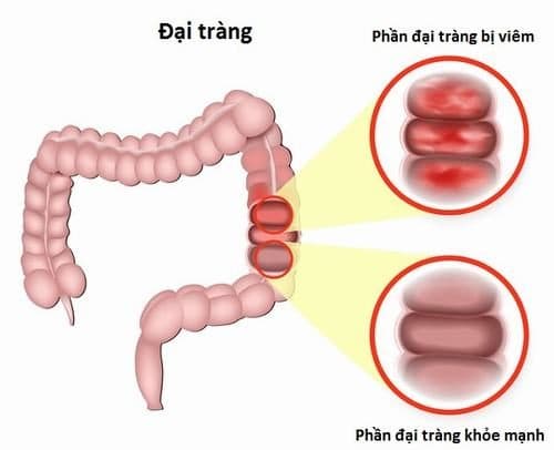 Viêm đại tràng là bệnh thường gặp ở đường tiêu hóa do nhiều nguyên nhân gây ra