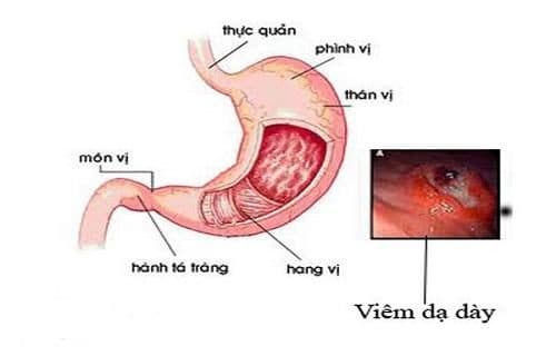Viêm dạ dày mạn tính là tình trạng quá phát của bệnh viêm dạ dày cấp tính