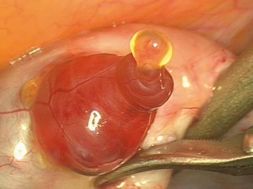 Nếu quan hệ đúng vào rụng trứng, khả năng mang thai là rất cao.