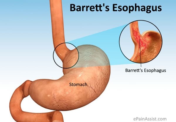 Cảnh giác với bệnh Barrett thực quản