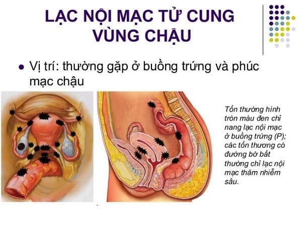 CA 125 có thể tăng trong trường hợp lạc nội mạc tử cung