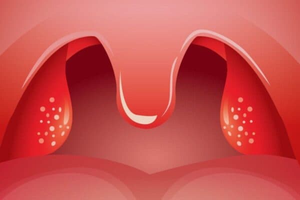 Viêm amidan khiến người bệnh thường xuyên đau họng, nuốt vướng