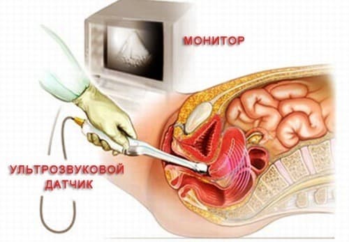 Có nên siêu âm đầu dò khi mới mang thai?