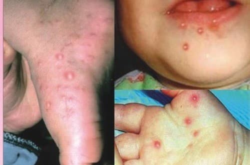 Tay chân miệng là nguyên nhân gây đau một bên họng