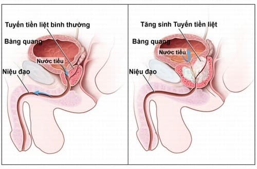 Viêm tuyến tiền liệt là bệnh lý khá phổ biến cần được phát hiện sớm và điều trị hiệu quả