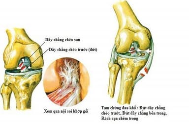Đứt dây chằng gối nguy hiểm không?