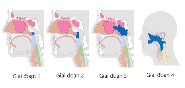 Bệnh nhân mắc ung thư vòm họng giai đoạn 2 sống được bao lâu?