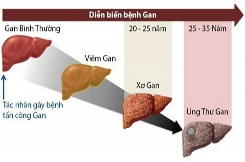 Viêm gan B diễn biến âm thầm và gây biến chứng nguy hiểm
