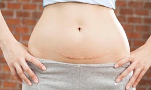 So với sinh thường, việc chăm sóc và hồi phục sức khỏe sau sinh mẹ cần quan tâm nhiều hơn.