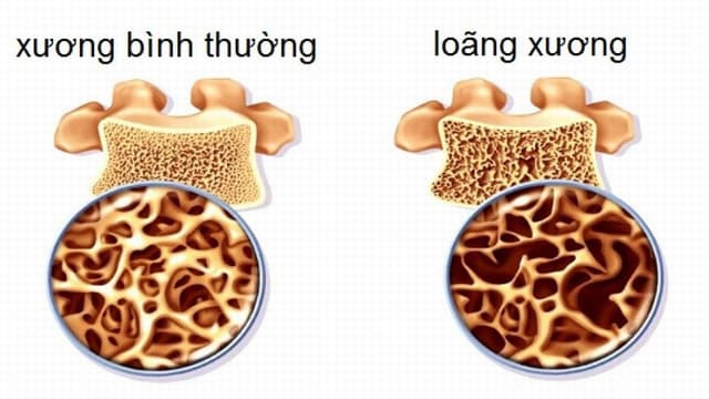 Tìm hiểu ngay: Mật độ xương bao nhiêu là bị loãng xương?