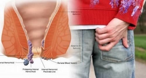 Ngứa hậu môn là tình trạng ngứa ngáy khó chịu có thể do sinh lý hoặc mắc bệnh lý nào đó