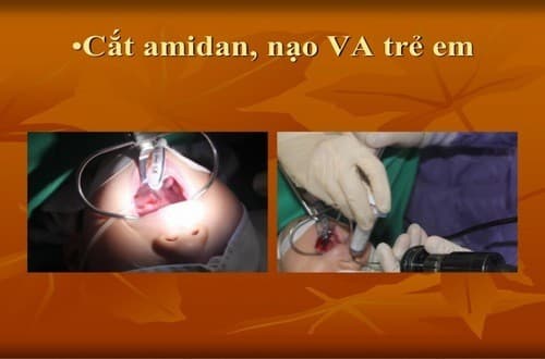 Nạo VA là chỉ định cần thiết với trẻ bị viêm VA tái phát, khó chữa trị bằng nội khoa