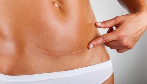 Mẹ nên mang thai sau ít nhất 24 tháng sau sinh mổ lần đầu. Đây là thời gian để vết sẹo cũ hồi phục