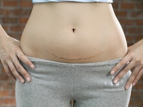 Nếu bạn đã sinh mổ 2 lần trước đó và muốn mang thai lần thứ 3 thì bạn phải chờ thời gian để cơ thể phục hồi. 