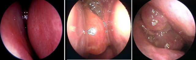 Sung huyết mũi là gì?gây nhiều biến chứng