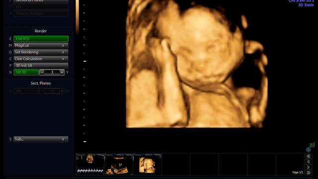 Siêu âm tuần 22 có tác dụng gì?phát hiện ra dị tật thai nhi